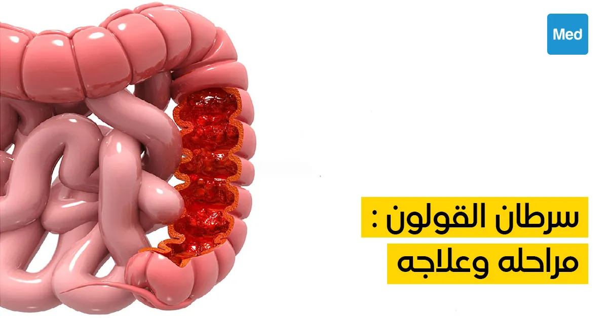 سرطان القولون : مراحله وعلاجه